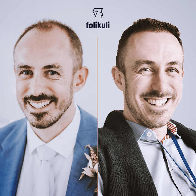 Folikuli - Transplantace vlasů v Turecku