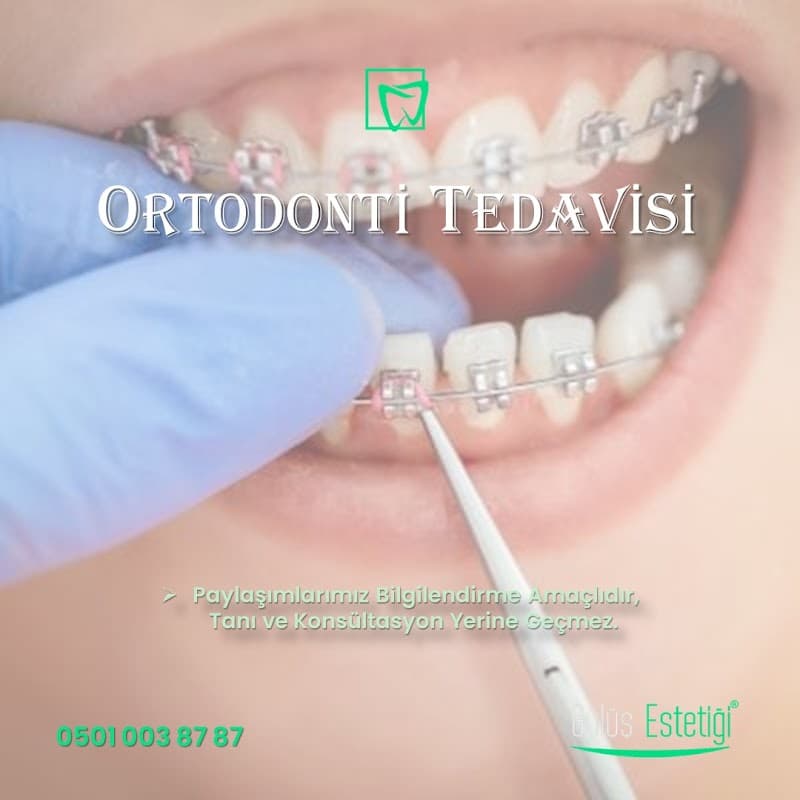 Gülüş Tasarımı Estetiği - Dental İmplant - Zirkonyum - Emax Lamine clinic photo