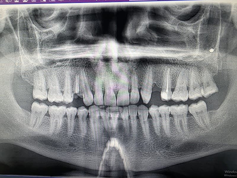 The best dental clinic in turkey | dental implants in turkey | All on 6 | All on 4 | Zirconium crowns | ALL ON X clinic