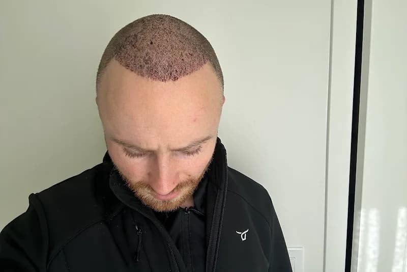 Smile Hair Clinic Hair Transplant Turkey Istanbul