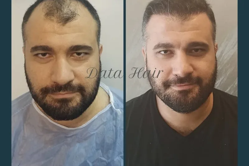 Data Hair Clinic & Eyyüp Tütüncü Saç Ekim Merkezi