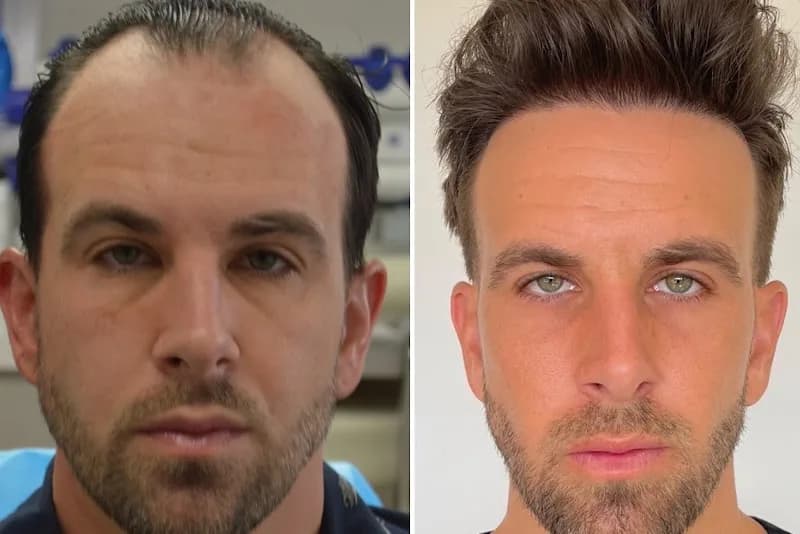 LA FUE Hair Clinic - Los Angeles FUE Hair Transplant Clinic