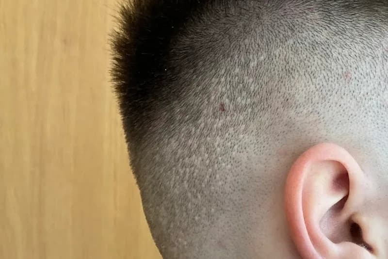 Clinical Hair&Health Robotická transplantace vlasů