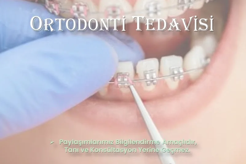 Gülüş Tasarımı Estetiği - Dental İmplant - Zirkonyum - Emax Lamine