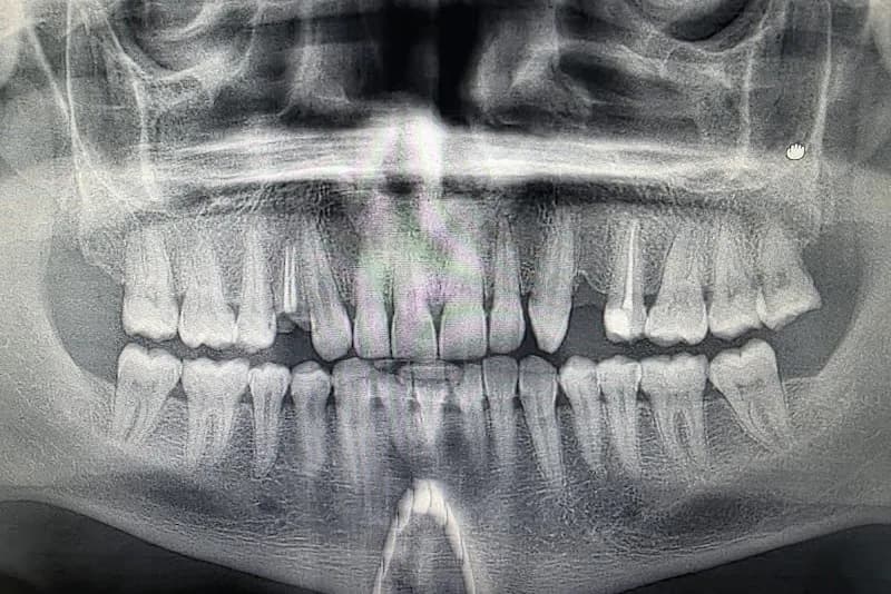 The best dental clinic in turkey | dental implants in turkey | All on 6 | All on 4 | Zirconium crowns | ALL ON X clinic